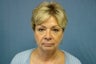 Face Lift and Blepharoplasty