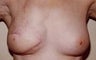 62 year old female patient 