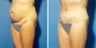 Abdominoplasty