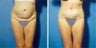 Abdominoplasty