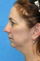Facelift