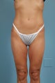 Thigh Lift Patient