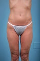 Thigh Lift Patient