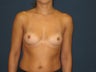 Breast Augmentation