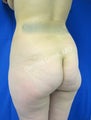 Butt Augmentation