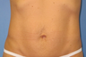 Exilis for skin tightening abdomen