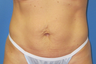 Exilis for skin tightening abdomen