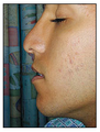 Rhinoplasty
