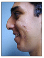 Rhinoplasty