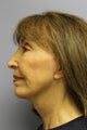 Lower Face / Neck Lift with Chin Aug 