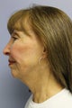 Lower Face / Neck Lift with Chin Aug 