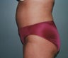 39-Year-Old Female Tummy Tuck, Liposuction 