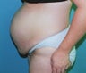 39-Year-Old Female Tummy Tuck, Liposuction 