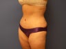 Abdominoplasty / Tummy tuck / Mommy Makeover 3/4 view