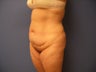 Abdominoplasty / Tummy tuck / Mommy Makeover 3/4 view