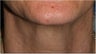 55 Year old female with aging neck due to neck bands.  She doesn't want a surgical neck lift