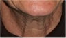 55 Year old female with aging neck due to neck bands.  She doesn't want a surgical neck lift