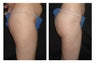 Brazilian Butt Lift 