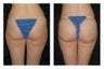 Brazilian Butt Lift 