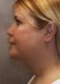 Liposuction Face and Neck