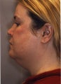 Liposuction Face and Neck