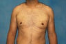 Male Breast Reduction