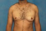Male Breast Reduction