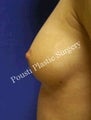 Nipple-Areola Repair