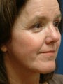Facelift, Eyelid Surgery and Laser