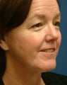 Facelift, Eyelid Surgery and Laser