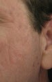 Fraxel repair for acne scars