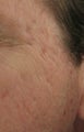 Fraxel repair for acne scars