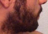 Before and After Beard Transplant