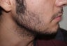 Before and After Beard Transplant