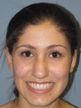 Otoplasty, Ear Surgery