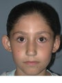 Otoplasty, Ear Surgery