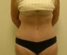Abdominoplasty