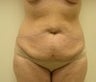 Abdominoplasty
