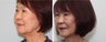 Before and 2 month after Face Lift photos 