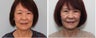 Before and 2 month after Face Lift photos 
