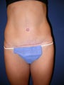 Tummy Tuck