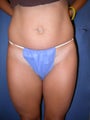 Tummy Tuck