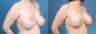 Revision Breast Surgery / Breast Implant Revision