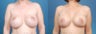 Revision Breast Surgery / Breast Implant Revision