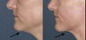 Ultherapy for under chin in 43 year old female