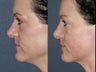 Ultherapy for under chin in 43 year old female