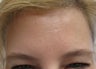 Botox