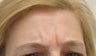Botox