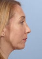 Female Chin Implant