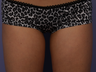 Zeltiq CoolSculpting to Inner Thighs
